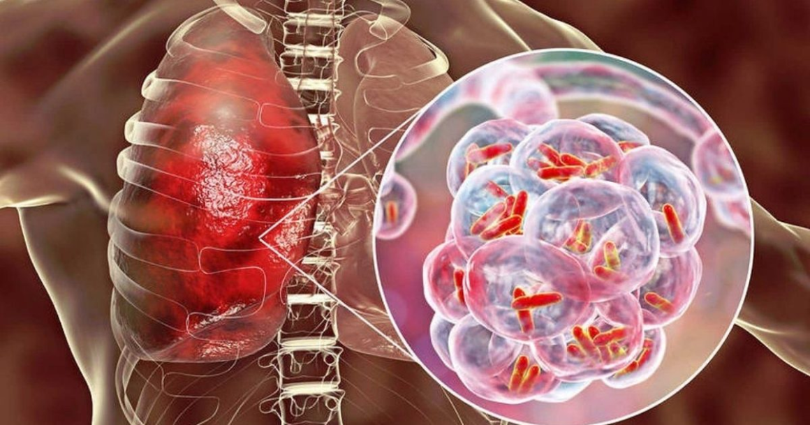 Tuberculosis en Nuevo Laredo: 192 pacientes están bajo control este 2026